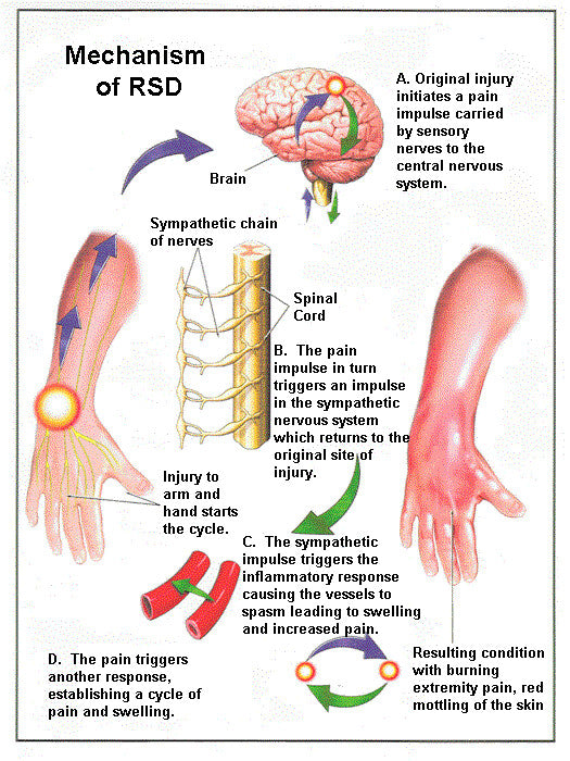 Reflex Sympathetic Dystrophy Cruisin Organics ®